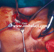 Eye Injuries 8 Eye Socket Floor Reconstructed With Bone Plate