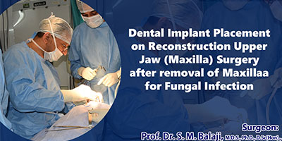 Facial Reconstruction Surgery of Upper Jaw after Treatment of Fungal Infection Followed By Dental Implant Surgery