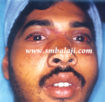 Eye Injuries 7 Fractured Right Eye Socket Bone