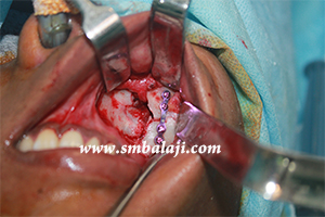 Jaw and TMJ Injuries 5 Fractured Segments Fixed With Bone Plate