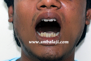 Jaw and TMJ Injuries 6 Improved Mouth Opening Postoperatively