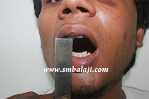 Jaw and TMJ Injuries 1 Jaw Fracture Surgery India