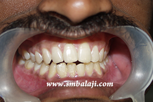 Jaw and TMJ Injuries 15 Occlusion Or The Way The Patient Bites Corrected After Surgery