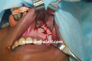 Jaw and TMJ Injuries 4 Open Reduction Of Fracture