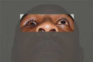 Eye Injuries 2 Facial Trauma Hospital India