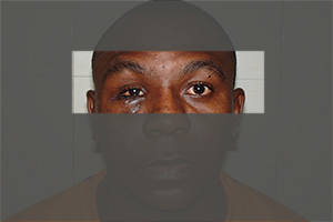 Eye Injuries 1 Facial Trauma Care In India