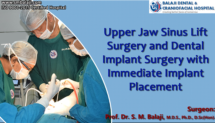 Upper jaw Sinus Lift Surgery for immediate dental implant placement