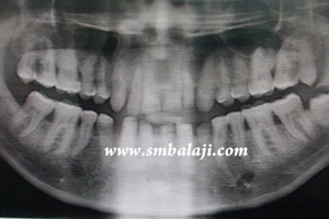 Jaw and TMJ Injuries 7 X-Ray Indicating A Fracture In The Left Side Of The Lower Jaw