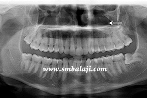 Jaw and TMJ Injuries 2 X-Ray Showing Jaw Fracture