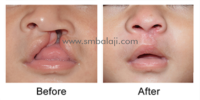 Cleft lip repair before after picture
