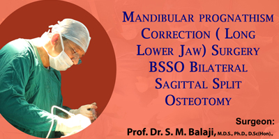 Mandibular prognathism Correction (Long Lower jaw) Surgery BSSO Bilateral Sagittal Split Osteotomy