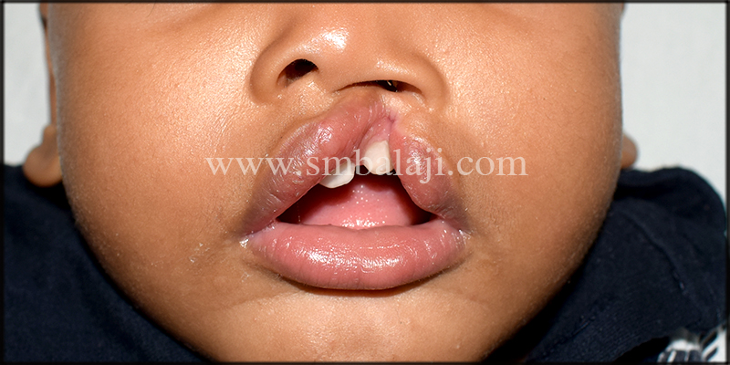 Pre-Operative View Showing Unilateral Cleft Lip And Palate
