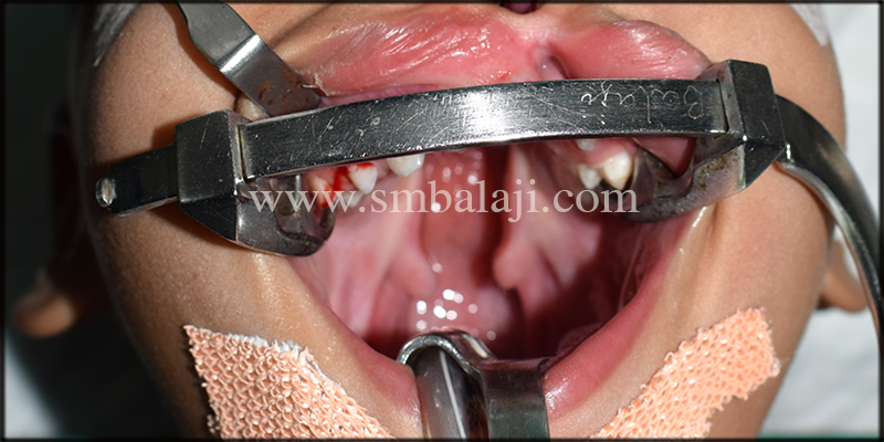 Pre-Operative View Showing Cleft Palate
