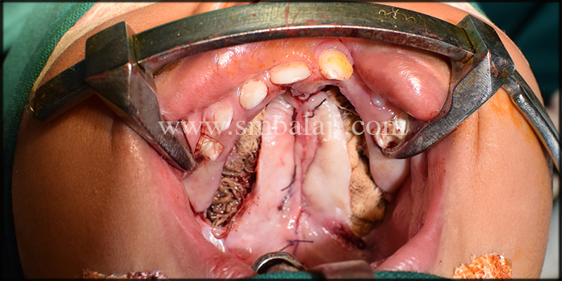 Post-Operative View Following Cleft Palate Repair