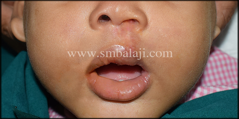 Post-Operative View Immediately After Suture Removal Showing An Enhanced Appearance Of The Baby