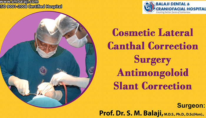 Cosmetic eye surgery with lateral canthopexy for antimongoloid slant correction