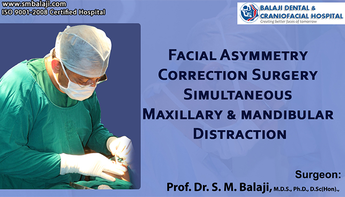 Facial Asymmetry Correction Surgery Simultaneous Maxillary & mandibular Distraction