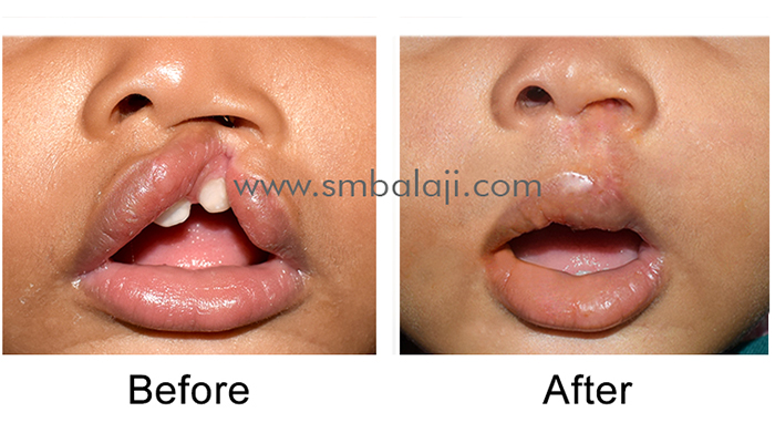 Simultaneous Unilateral cleft lip and palate repair