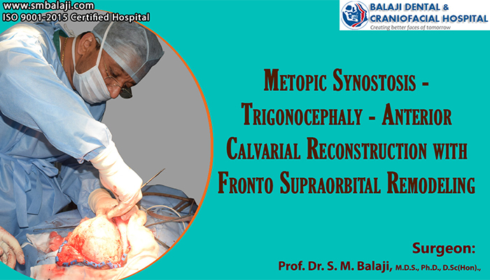 Metopic synostosis – Trigonocephaly – Anterior Calvarial Reconstruction with Fronto Supraorbital Remodeling