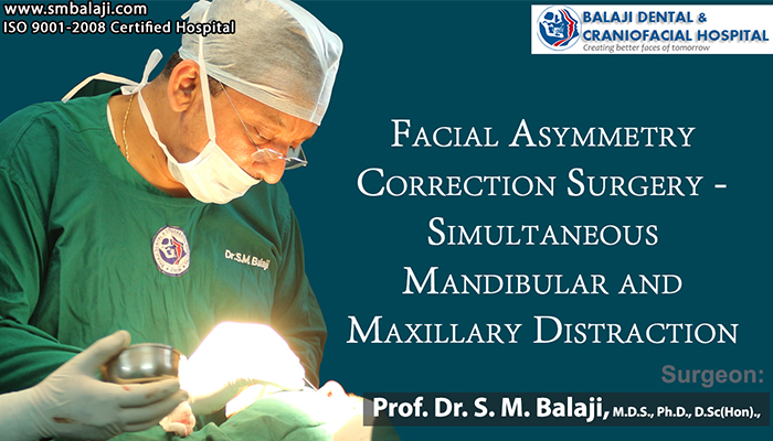 Facial Asymmetry Correction Surgery – Simultaneous Mandibular and Maxillary Distraction