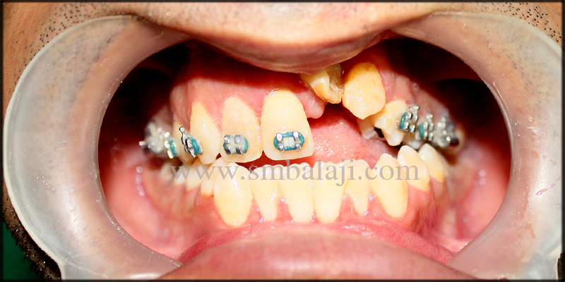 Fixed Ceramic Prosthesis for Unilateral Cleft Patient with Autogenous Graft 1 Patient Before Surgery With Rotated Upper Left Anteriors
