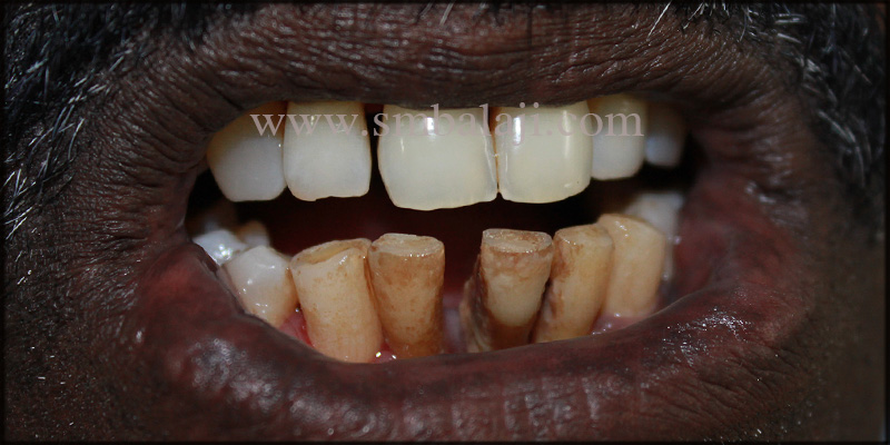 Patient With Discolored, Mobile Lower Front Teeth