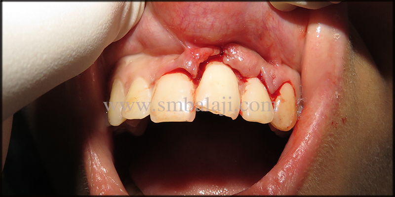 Patient With Lacerated Gums And Displaced Tooth After The Traumatic Fall