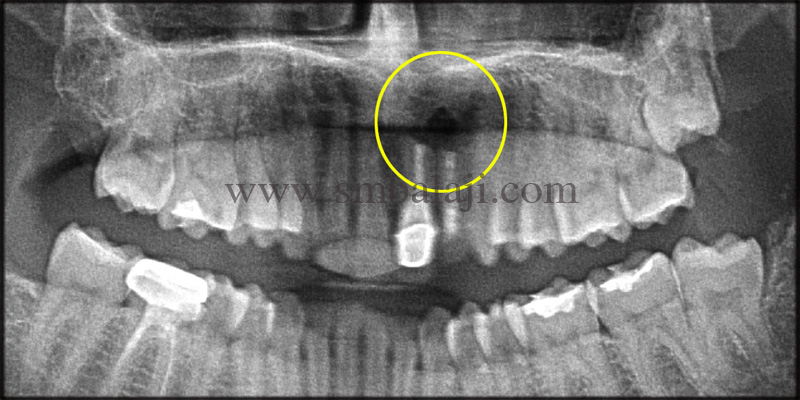 Pre Operative X-Ray Indicating Infection At The Root Tip Of Upper Front Teeth