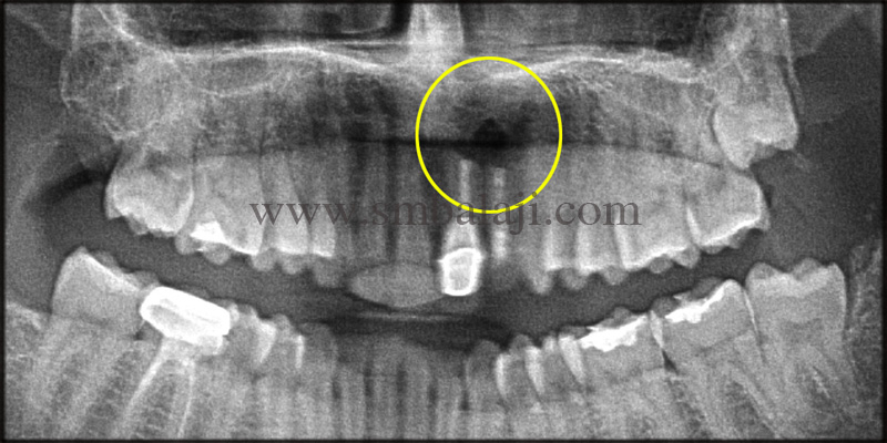 Immediate Dental Implant followed by cyst removal and bone graft 1 Pre Operative X-Ray Indicating Infection At The Root Tip Of Upper Front Teeth