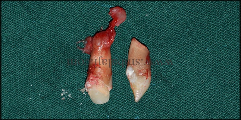Extracted Infected Teeth With The Cyst