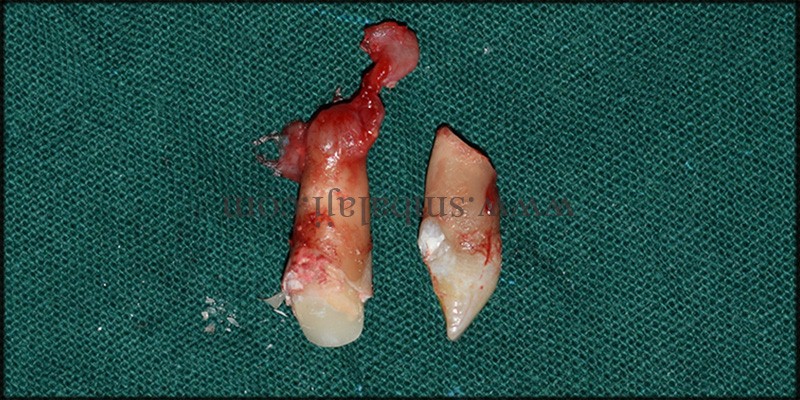 Immediate Dental Implant followed by cyst removal and bone graft 2 Extracted Infected Teeth With The Cyst