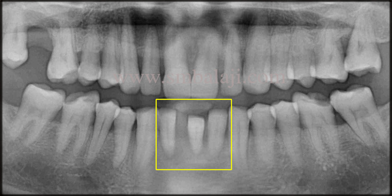 Pre-Operative Opg Indicating Severe Bone Loss