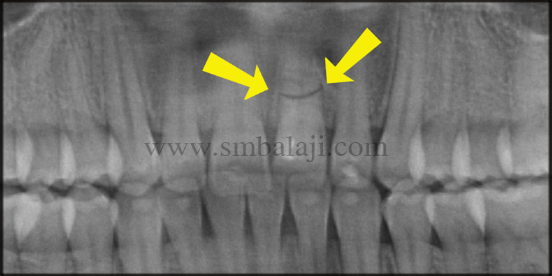 Replacement of Fractured Tooth with Dental Implant 2 Pre-Operative Opg Showing Horizontal Root Fracture Of The Tooth