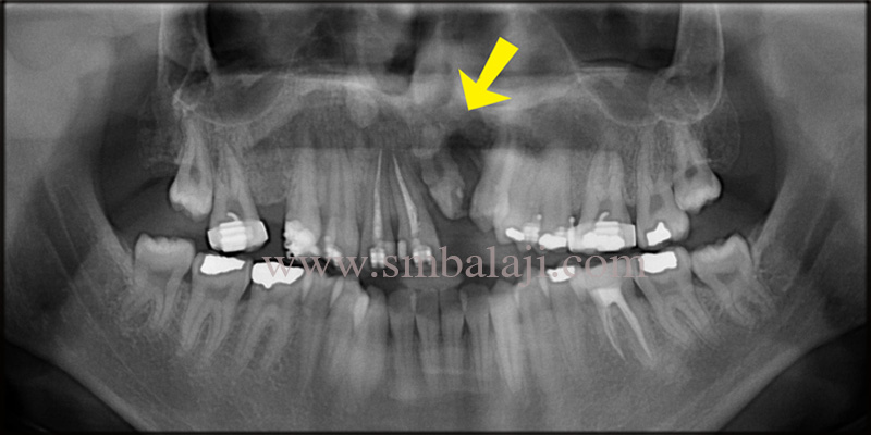 Pre Operative Opg Showing Rotated Teeth With Incomplete Root Formation And Bone Defect