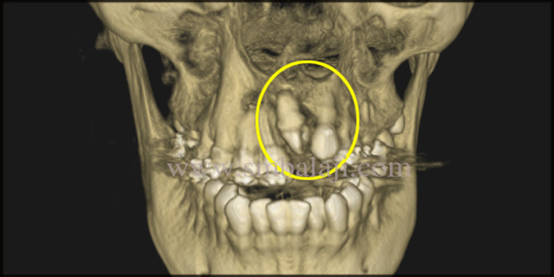 Cbct Image Indicating Deficinet Bone Formation And Upper Left Lateral Incisor
