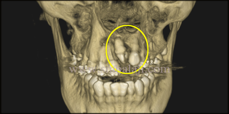 Fixed Ceramic Prosthesis for Unilateral Cleft Patient with Autogenous Graft 3 Cbct Image Indicating Deficinet Bone Formation And Upper Left Lateral Incisor