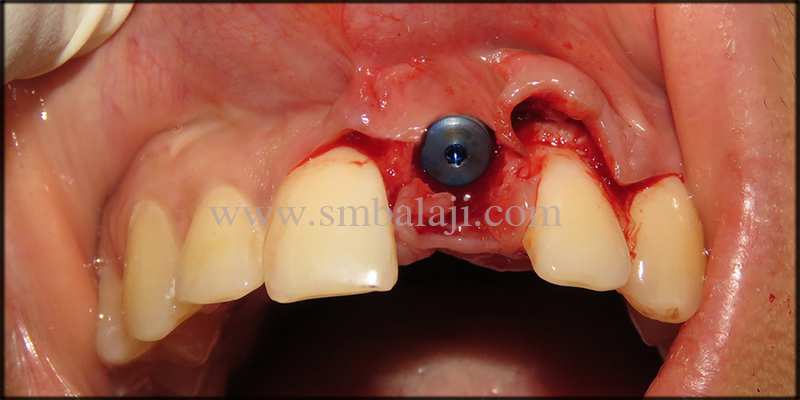 Immediate Dental Implant Placed In The Empty Tooth Socket With Stability