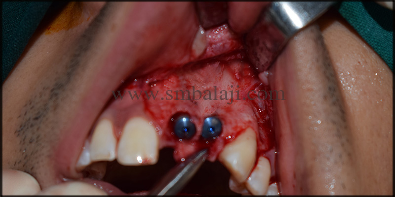 Immediate Dental Implant followed by cyst removal and bone graft 3 Implant Placed With Stability And Retention