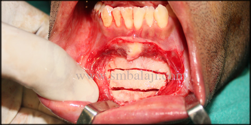 Fixed Ceramic Prosthesis for Unilateral Cleft Patient with Autogenous Graft 4 Bone Graft Taken From Mandibular Symphysis