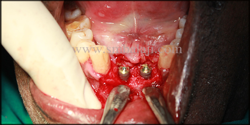 Immediate Dental Implant Placed With Stability And Retention