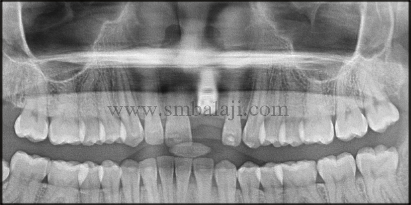 Replacement of Fractured Tooth with Dental Implant 4 Post-Operative Opg Showing Well Positioned Implant At The Relative Site