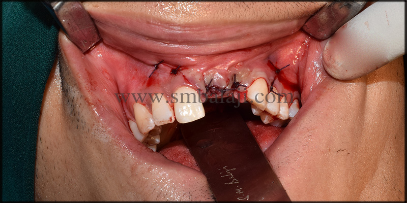 Immediate Dental Implant followed by cyst removal and bone graft 4 Tissue Approximated With Dissolvable Suture