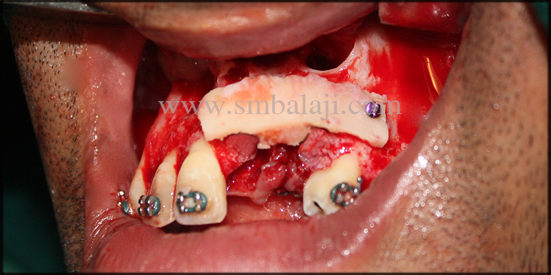 Fixed Ceramic Prosthesis for Unilateral Cleft Patient with Autogenous Graft 5 Autogenous Bone Graft Placed In Bone Defect By Means If Fixed Screws