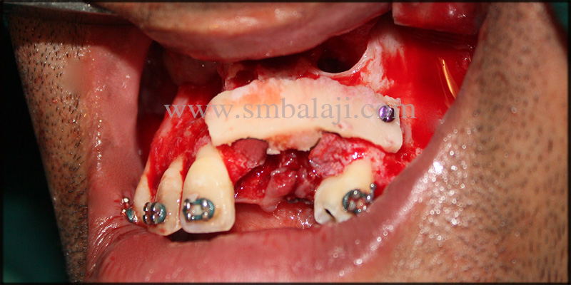 Autogenous Bone Graft Placed In Bone Defect By Means If Fixed Screws