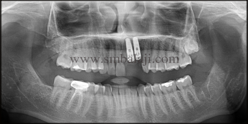 Immediate Dental Implant followed by cyst removal and bone graft 5 Post-Operative Opg Shows Well Integrated Implant With The Jaw Bone