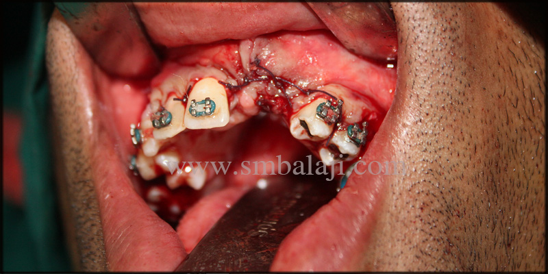 Fixed Ceramic Prosthesis for Unilateral Cleft Patient with Autogenous Graft 6 Gingival Tissue Approximated With Dissolvable Suture