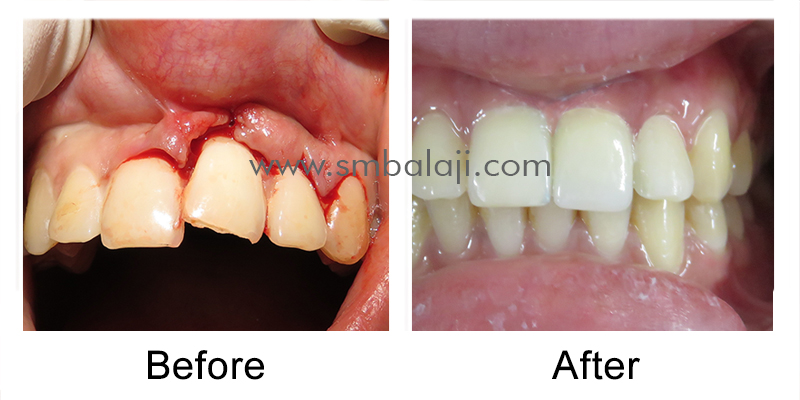 Replacement of Fractured Tooth with Dental Implant before after picture