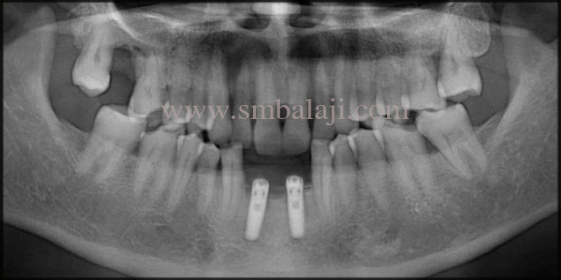 Post- Operative Opg Showing Osseointegrated Dental Implants