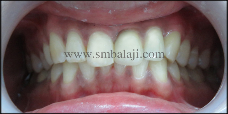 Patient With Fixed Ceramic Prosthesis Which Gives A Natural Well Blended Appearance