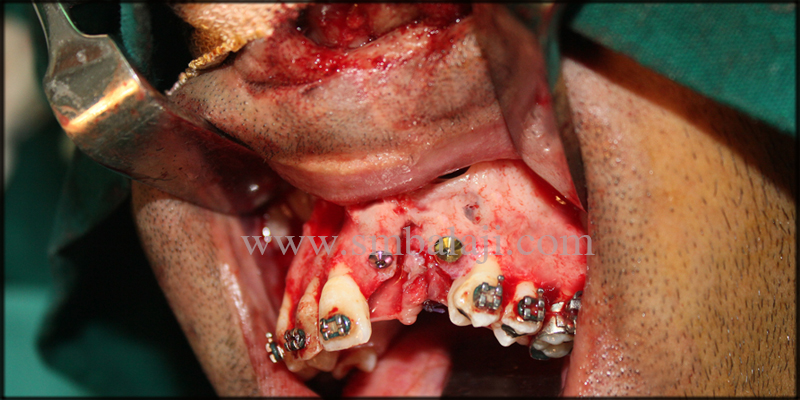 Fixed Ceramic Prosthesis for Unilateral Cleft Patient with Autogenous Graft 7 Dental Implants Placed With Stability And Retention